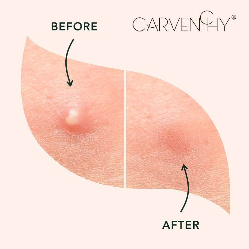 MIRACLE PATCH Hydrocolloid Acne Stickers Waterproof Invisible Ultra-Thin for Blemish Treatment (96 Patches) - Price Value Store