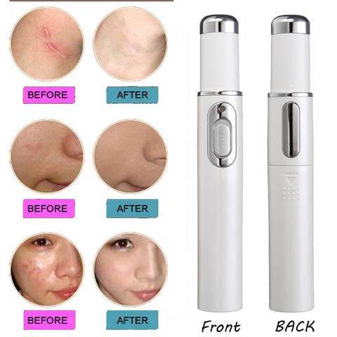 FDA-Cleared Blue Light Acne Killer | No-Skin-Contact Design - Price Value Store